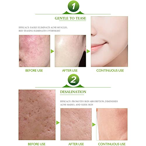 Aichun Beauty, Strong Acene ointment Acene Outispot on, Acene Cream 3 days Acne out, Spot on 30ml