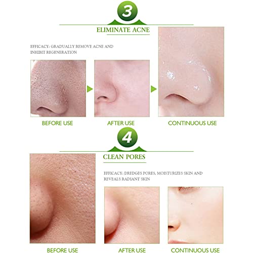 Aichun Beauty, Strong Acene ointment Acene Outispot on, Acene Cream 3 days Acne out, Spot on 30ml